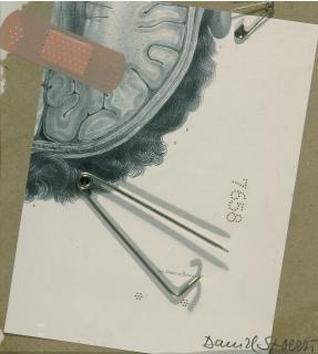 Daniel Spoerri - Aus der Serie: La médecine opératoire dessinée d’après nature