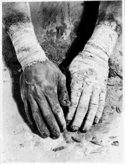 Dieter Appelt - Bandaged Hands