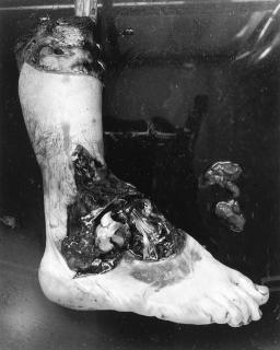 Frederick Sommer - Untitled (Amputated Foot) (1939)