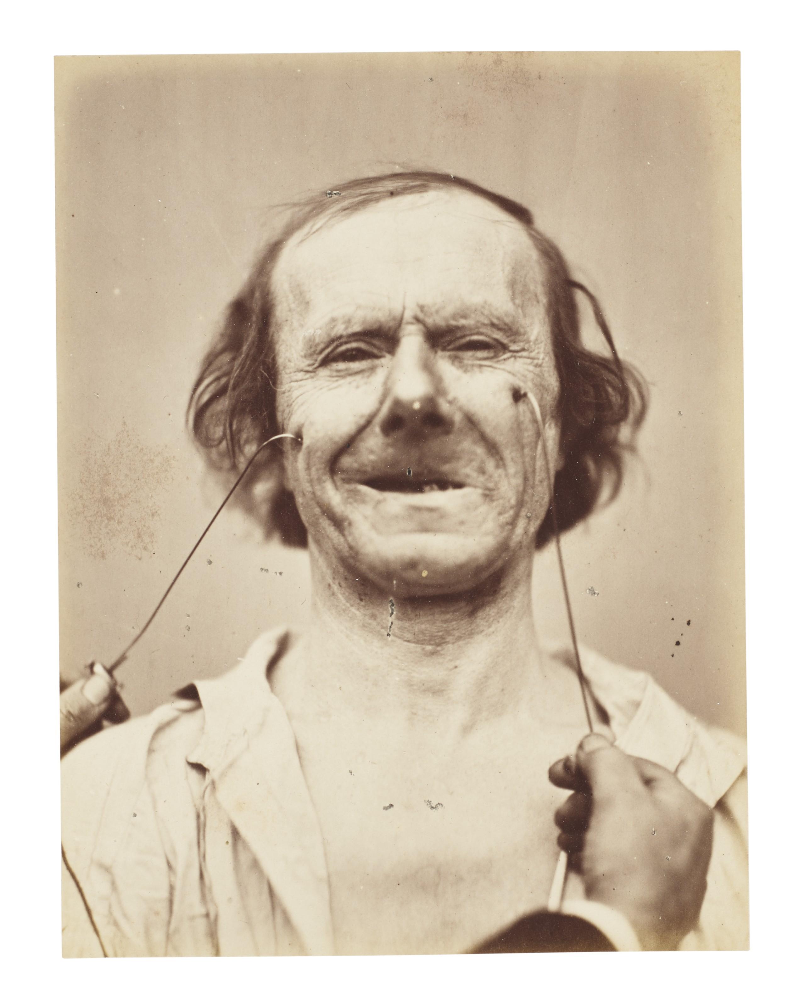 Guillaume-Benjamin Duchenne De Boulogne - Personage Masculin, From Mecanisme De La Physionomie Humaine, C. 1865