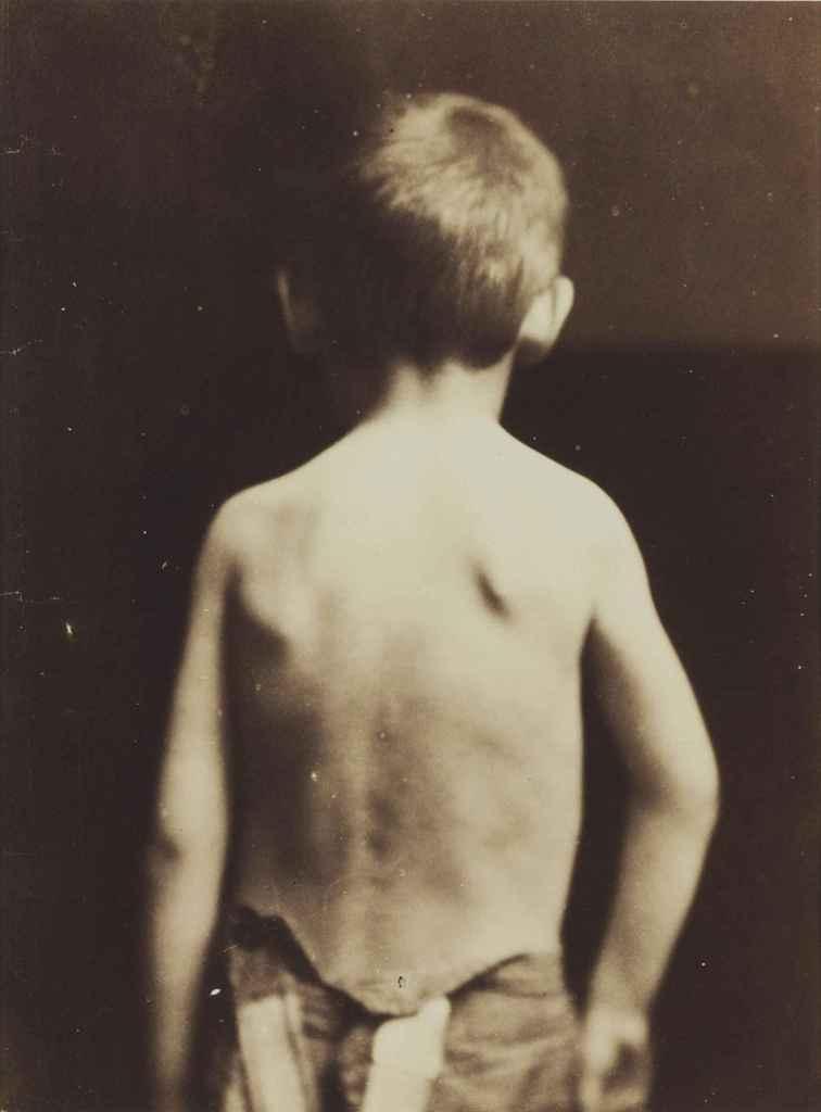 Guillaume Duchenne de Boulogne - Studies from Photographies Pathologiques, 1865
