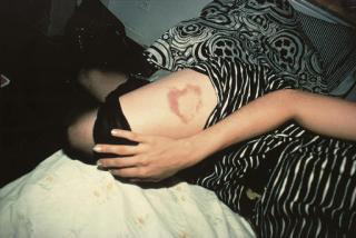 Nan Goldin - Heart-Shaped Bruise, N.Y.C.
