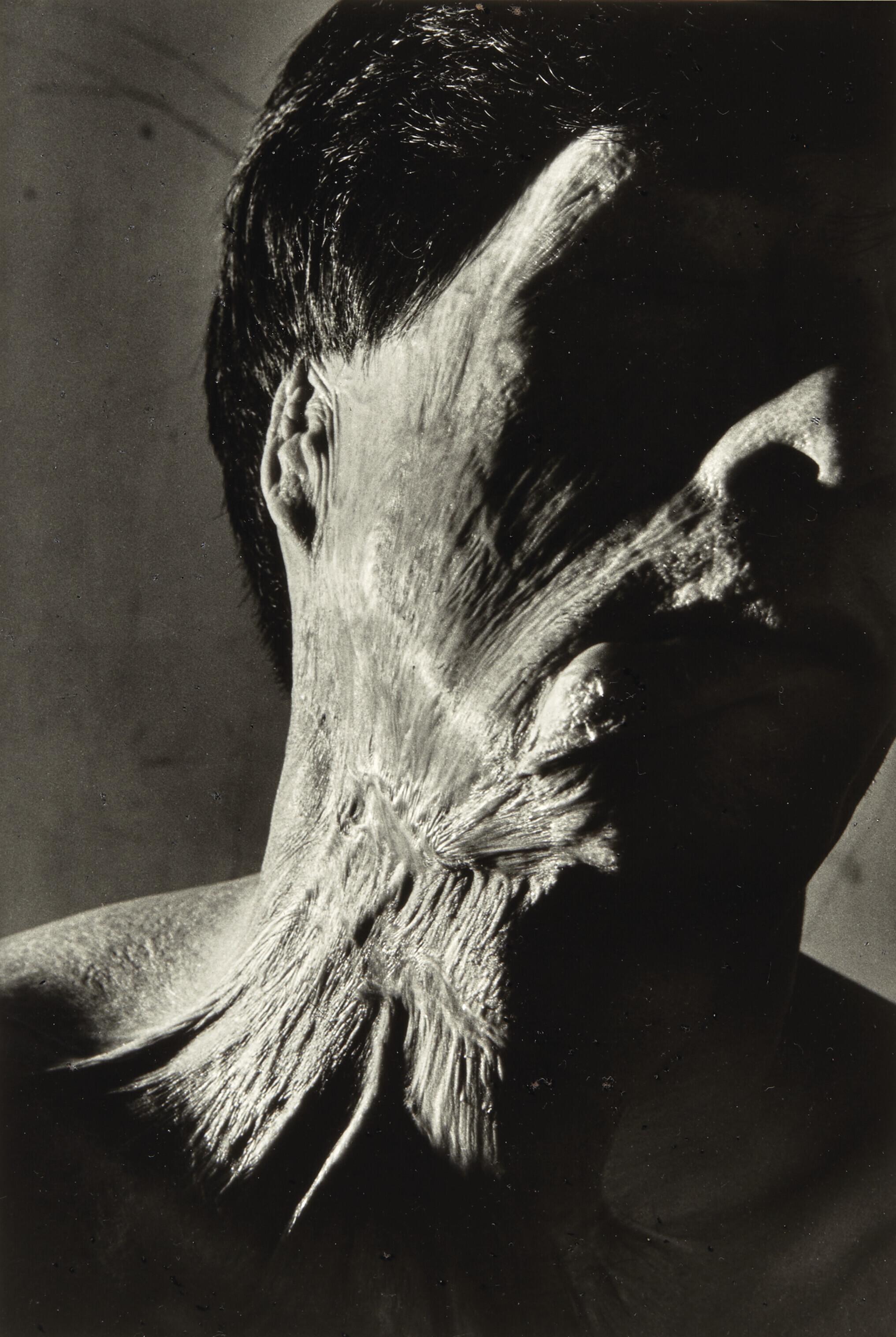 Shomei Tomatsu - Senji Yamaguchi (à 1,2 km de l’épicentre de l’explosion), de la série \'11h02, Nagasaki\', 1962