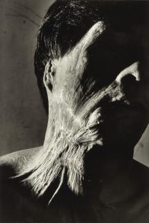 Shomei Tomatsu - Senji Yamaguchi (à 1,2 km de l’épicentre de l’explosion), de la série \'11h02, Nagasaki\', 1962