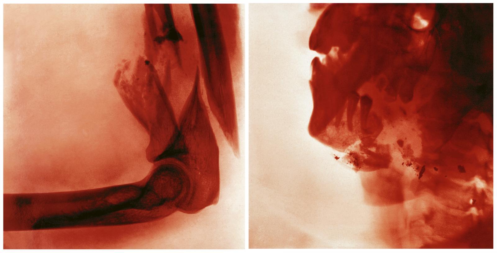 Via Lewandowsky - Kawumm (02) und Kawumm (03)